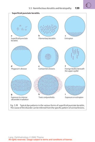 139
Superficial punctate keratitis.
Superficial punctate
keratitis
a b c
d e f
g h i
Filamentary keratitis Entropion
Thygeson's disease Contact lens lesions Foreign bodies beneath
the upper eyelid
Exposure to intense
ultraviolet irradiation
Toxic conjunctivitis Exposure or ectropion
Fig. 5.11 Typical dye patterns in the various forms of superficial punctate keratitis.
The cause of the disorder can be inferred from the specific pattern of corneal lesions.
5.5 Noninfectious Keratitis and Keratopathy
Lang, Ophthalmology © 2000 Thieme
All rights reserved. Usage subject to terms and conditions of license.
 
