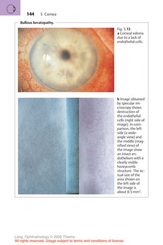 144
Bullous keratopathy.
Fig. 5.13
a Corneal edema
due to a lack of
endothelial cells.
b Image obtained
by specular mi-
croscopy shows
destruction of
the endothelial
cells (right side of
image). In com-
parison, the left
side (a wide-
angle view) and
the middle (mag-
nified view) of
the image show
an intact en-
dothelium with a
clearly visible
honeycomb
structure. The ac-
tual size of the
area shown on
the left side of
the image is
about 0.5 mm2
.
5 Cornea
Lang, Ophthalmology © 2000 Thieme
All rights reserved. Usage subject to terms and conditions of license.
 