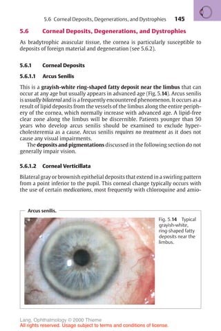 145
5.6 Corneal Deposits, Degenerations, and Dystrophies
As bradytrophic avascular tissue, the cornea is particularly susceptible to
deposits of foreign material and degeneration (see 5.6.2).
5.6.1 Corneal Deposits
5.6.1.1 Arcus Senilis
This is a grayish-white ring-shaped fatty deposit near the limbus that can
occur at any age but usually appears in advanced age (Fig. 5.14). Arcus senilis
is usually bilateral and is a frequently encountered phenomenon. It occurs as a
result of lipid deposits from the vessels of the limbus along the entire periph-
ery of the cornea, which normally increase with advanced age. A lipid-free
clear zone along the limbus will be discernible. Patients younger than 50
years who develop arcus senilis should be examined to exclude hyper-
cholesteremia as a cause. Arcus senilis requires no treatment as it does not
cause any visual impairments.
The deposits and pigmentations discussed in the following section do not
generally impair vision.
5.6.1.2 Corneal Verticillata
Bilateral gray or brownish epithelial deposits that extend in a swirling pattern
from a point inferior to the pupil. This corneal change typically occurs with
the use of certain medications, most frequently with chloroquine and amio-
Arcus senilis.
Fig. 5.14 Typical
grayish-white,
ring-shaped fatty
deposits near the
limbus.
5.6 Corneal Deposits, Degenerations, and Dystrophies
Lang, Ophthalmology © 2000 Thieme
All rights reserved. Usage subject to terms and conditions of license.
 