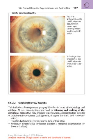 147
5.6.2.2 Peripheral Furrow Keratitis
This includes a heterogeneous group of disorders in terms of morphology and
etiology. All are noninfectious and lead to thinning and melting of the
peripheral cornea that may progress to perforation. Etiologic factors include:
❖ Autoimmune processes (collagenosis, marginal keratitis, and scleroker-
atitis).
❖ Trophic dysfunctions (pitting due to lack of tear film).
❖ Unknown degenerative processes (Terrien’s marginal degeneration or
Mooren’s ulcer).
Calcific band keratopathy.
Fig. 5.15
a Brownish-white
calcific deposits
occur in Bow-
man’s layer,
severely impair-
ing the patient’s
vision.
b Findings after
chelation of the
calcific deposits
with an EDTA so-
lution.
5.6 Corneal Deposits, Degenerations, and Dystrophies
Lang, Ophthalmology © 2000 Thieme
All rights reserved. Usage subject to terms and conditions of license.
 