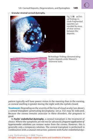149
Granular stromal corneal dystrophy.
Fig. 5.16 a Clini-
cal findings in-
clude fragmented
opacities sur-
rounded by areas
of clear cornea
between the
deposits.
b Histologic findings demonstrating
hyaline deposits under Masson’s
trichrome stain.
patient typically will have poorer vision in the morning than in the evening,
as corneal swelling is greater during the night with the eyelids closed.
Treatment: Depending on the severity of the loss of visual acuity (see above),
a corneal transplant (penetrating keratoplasty; see p. 152) may be indicated.
Because the cornea remains avascular in these disorders, the prognosis is
good.
In Fuchs’ endothelial dystrophy, a corneal transplant is the treatment of
choice. Where the symptoms are not too far advanced, frequent application of
hyperosmolar solutions can remove water from the cornea. However, this is
generally only a temporary solution. The corneal transplant is performed in
combination with a cataract extraction; patients with Fuchs’ endothelial dys-
5.6 Corneal Deposits, Degenerations, and Dystrophies
Lang, Ophthalmology © 2000 Thieme
All rights reserved. Usage subject to terms and conditions of license.
 
