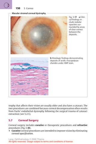 150
Macular stromal corneal dystrophy.
Fig. 5.17 a Clini-
cal findings in-
clude nodular
opacities sur-
rounded by areas
of clear cornea
between the
deposits.
b Histologic findings demonstrating
deposits of acidic mucopolysac-
charides under AMP stain.
trophy that affects their vision are usually older and also have a cataract. The
two procedures are combined because corneal decompensation often results
from Fuchs’ endothelial dystrophy following the surgical trauma of cataract
extraction (see 5.2.5).
5.7 Corneal Surgery
Corneal surgery includes curative or therapeutic procedures and refractive
procedures (Fig. 5.18).
❖ Curative corneal procedures are intended to improve vision by eliminating
corneal opacification.
5 Cornea
Lang, Ophthalmology © 2000 Thieme
All rights reserved. Usage subject to terms and conditions of license.
 