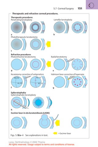 151
Therapeutic and refractive corneal procedures.
46.OD
42.5D
43.5D
42.5D
Therapeutic procedures
Refractive procedures
Epikeratophakia
Excimer laser in situ keratomileusis (LASIK)
a b
Penetrating keratoplasty Lamellar keratoplasty
Phototherapeutic keratectomy
c
Photorefractive keratectomy
d e
Radial keratotomy
f
Keratotomy correction of astigmatism
g
Holmium laser correction of hyperopia
Epikeratophakic keratoplasty
h
i
= Excimer laser
Figs. 5.18a–i See explanations in text.
5.7 Corneal Surgery
Lang, Ophthalmology © 2000 Thieme
All rights reserved. Usage subject to terms and conditions of license.
 