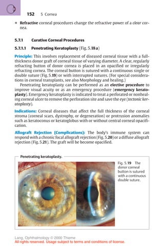 152
❖ Refractive corneal procedures change the refractive power of a clear cor-
nea.
5.7.1 Curative Corneal Procedures
5.7.1.1 Penetrating Keratoplasty (Fig. 5.18a)
Principle: This involves replacement of diseased corneal tissue with a full-
thickness donor graft of corneal tissue of varying diameter. A clear, regularly
refracting button of donor cornea is placed in an opacified or irregularly
refracting cornea. The corneal button is sutured with a continuous single or
double suture (Fig. 5.19) or with interrupted sutures. (For special considera-
tions in corneal transplants, see also Morphology and healing.)
Penetrating keratoplasty can be performed as an elective procedure to
improve visual acuity or as an emergency procedure (emergency kerato-
plasty). Emergency keratoplasty is indicated to treat a perforated or nonheal-
ing corneal ulcer to remove the perforation site and save the eye (tectonic ker-
atoplasty).
Indications: Corneal diseases that affect the full thickness of the corneal
stroma (corneal scars, dystrophy, or degeneration) or protrusion anomalies
such as keratoconus or keratoglobus with or without central corneal opacifi-
cation.
Allograft Rejection (Complications): The body’s immune system can
respond with a chronic focal allograft rejection (Fig. 5.20) or a diffuse allograft
rejection (Fig. 5.21). The graft will be become opacified.
Penetrating keratoplasty.
Fig. 5.19 The
donor corneal
button is sutured
with a continuous
double suture.
5 Cornea
Lang, Ophthalmology © 2000 Thieme
All rights reserved. Usage subject to terms and conditions of license.
 