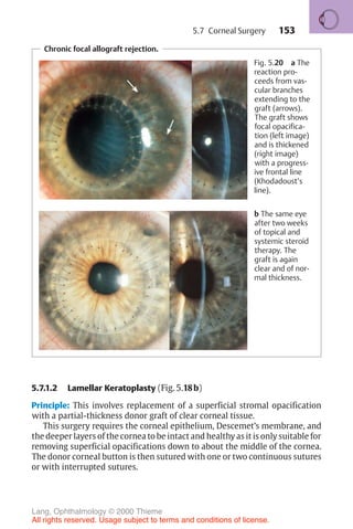 153
5.7.1.2 Lamellar Keratoplasty (Fig. 5.18b)
Principle: This involves replacement of a superficial stromal opacification
with a partial-thickness donor graft of clear corneal tissue.
This surgery requires the corneal epithelium, Descemet’s membrane, and
the deeper layers of the cornea to be intact and healthy as it is only suitable for
removing superficial opacifications down to about the middle of the cornea.
The donor corneal button is then sutured with one or two continuous sutures
or with interrupted sutures.
Chronic focal allograft rejection.
Fig. 5.20 a The
reaction pro-
ceeds from vas-
cular branches
extending to the
graft (arrows).
The graft shows
focal opacifica-
tion (left image)
and is thickened
(right image)
with a progress-
ive frontal line
(Khodadoust’s
line).
b The same eye
after two weeks
of topical and
systemic steroid
therapy. The
graft is again
clear and of nor-
mal thickness.
5.7 Corneal Surgery
Lang, Ophthalmology © 2000 Thieme
All rights reserved. Usage subject to terms and conditions of license.
 