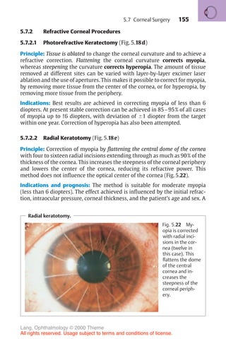 155
5.7.2 Refractive Corneal Procedures
5.7.2.1 Photorefractive Keratectomy (Fig. 5.18d)
Principle: Tissue is ablated to change the corneal curvature and to achieve a
refractive correction. Flattening the corneal curvature corrects myopia,
whereas steepening the curvature corrects hyperopia. The amount of tissue
removed at different sites can be varied with layer-by-layer excimer laser
ablation and the use of apertures. This makes it possible to correct for myopia,
by removing more tissue from the center of the cornea, or for hyperopia, by
removing more tissue from the periphery.
Indications: Best results are achieved in correcting myopia of less than 6
diopters. At present stable correction can be achieved in 85–95% of all cases
of myopia up to !6 diopters, with deviation of !1 diopter from the target
within one year. Correction of hyperopia has also been attempted.
5.7.2.2 Radial Keratotomy (Fig. 5.18e)
Principle: Correction of myopia by flattening the central dome of the cornea
with four to sixteen radial incisions extending through as much as 90% of the
thickness of the cornea. This increases the steepness of the corneal periphery
and lowers the center of the cornea, reducing its refractive power. This
method does not influence the optical center of the cornea (Fig. 5.22).
Indications and prognosis: The method is suitable for moderate myopia
(less than 6 diopters). The effect achieved is influenced by the initial refrac-
tion, intraocular pressure, corneal thickness, and the patient’s age and sex. A
Radial keratotomy.
Fig. 5.22 My-
opia is corrected
with radial inci-
sions in the cor-
nea (twelve in
this case). This
flattens the dome
of the central
cornea and in-
creases the
steepness of the
corneal periph-
ery.
5.7 Corneal Surgery
Lang, Ophthalmology © 2000 Thieme
All rights reserved. Usage subject to terms and conditions of license.
 