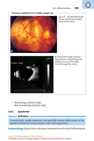 159
Posterior staphyloma in a highly myopic eye.
Fig. 6.1 a Ophthalmologic
image of posterior staphy-
loma of the sclera.
b Ultrasound image showing
the posterior scleral bulge and
oblique course of the optic
nerve through the sclera.
– Necrotizing (scleritis only).
– Non-necrotizing (scleritis only).
6.6.1 Episcleritis
Definition
Circumscribed, usually segmental, and generally nodular inflammation of the
episclera (connective tissue between sclera and conjunctiva).
Epidemiology: Episcleritis is the most common form of scleral inflammation.
6.6 Inflammations
Lang, Ophthalmology © 2000 Thieme
All rights reserved. Usage subject to terms and conditions of license.
 