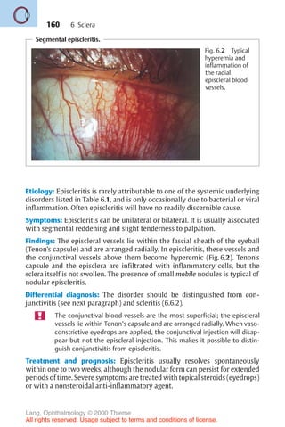 160
Etiology: Episcleritis is rarely attributable to one of the systemic underlying
disorders listed in Table 6.1, and is only occasionally due to bacterial or viral
inflammation. Often episcleritis will have no readily discernible cause.
Symptoms: Episcleritis can be unilateral or bilateral. It is usually associated
with segmental reddening and slight tenderness to palpation.
Findings: The episcleral vessels lie within the fascial sheath of the eyeball
(Tenon’s capsule) and are arranged radially. In episcleritis, these vessels and
the conjunctival vessels above them become hyperemic (Fig. 6.2). Tenon’s
capsule and the episclera are infiltrated with inflammatory cells, but the
sclera itself is not swollen. The presence of small mobile nodules is typical of
nodular episcleritis.
Differential diagnosis: The disorder should be distinguished from con-
junctivitis (see next paragraph) and scleritis (6.6.2).
The conjunctival blood vessels are the most superficial; the episcleral
vessels lie within Tenon’s capsule and are arranged radially. When vaso-
constrictive eyedrops are applied, the conjunctival injection will disap-
pear but not the episcleral injection. This makes it possible to distin-
guish conjunctivitis from episcleritis.
Treatment and prognosis: Episcleritis usually resolves spontaneously
within one to two weeks, although the nodular form can persist for extended
periods of time. Severe symptoms are treated with topical steroids (eyedrops)
or with a nonsteroidal anti-inflammatory agent.
Segmental episcleritis.
Fig. 6.2 Typical
hyperemia and
inflammation of
the radial
episcleral blood
vessels.
6 Sclera
Lang, Ophthalmology © 2000 Thieme
All rights reserved. Usage subject to terms and conditions of license.
 