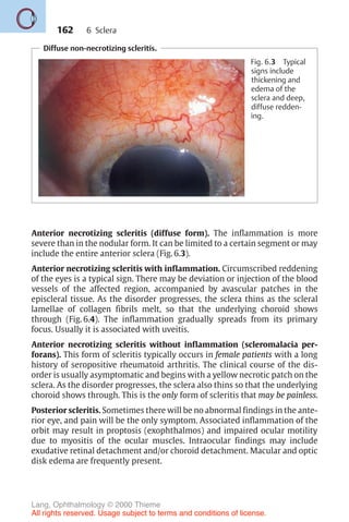 162
Anterior necrotizing scleritis (diffuse form). The inflammation is more
severe than in the nodular form. It can be limited to a certain segment or may
include the entire anterior sclera (Fig. 6.3).
Anterior necrotizing scleritis with inflammation. Circumscribed reddening
of the eyes is a typical sign. There may be deviation or injection of the blood
vessels of the affected region, accompanied by avascular patches in the
episcleral tissue. As the disorder progresses, the sclera thins as the scleral
lamellae of collagen fibrils melt, so that the underlying choroid shows
through (Fig. 6.4). The inflammation gradually spreads from its primary
focus. Usually it is associated with uveitis.
Anterior necrotizing scleritis without inflammation (scleromalacia per-
forans). This form of scleritis typically occurs in female patients with a long
history of seropositive rheumatoid arthritis. The clinical course of the dis-
order is usually asymptomatic and begins with a yellow necrotic patch on the
sclera. As the disorder progresses, the sclera also thins so that the underlying
choroid shows through. This is the only form of scleritis that may be painless.
Posterior scleritis. Sometimes there will be no abnormal findings in the ante-
rior eye, and pain will be the only symptom. Associated inflammation of the
orbit may result in proptosis (exophthalmos) and impaired ocular motility
due to myositis of the ocular muscles. Intraocular findings may include
exudative retinal detachment and/or choroid detachment. Macular and optic
disk edema are frequently present.
6 Sclera
Diffuse non-necrotizing scleritis.
Fig. 6.3 Typical
signs include
thickening and
edema of the
sclera and deep,
diffuse redden-
ing.
Lang, Ophthalmology © 2000 Thieme
All rights reserved. Usage subject to terms and conditions of license.
 
