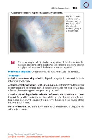 163
Circumscribed scleral staphyloma secondary to scleritis.
Fig. 6.4 The un-
derlying choroid
shows through at
the bulge where
the sclera is
thinned, giving it
a bluish tinge.
The reddening in scleritis is due to injection of the deeper vascular
plexus on the sclera and to injection of the episclera. Inspecting the eye
in daylight will best reveal the layer of maximum injection.
Differential diagnosis: Conjunctivitis and episcleritis (see that section).
Treatment:
Anterior non-necrotizing scleritis. Topical or systemic nonsteroidal anti-
inflammatory therapy.
Anterior necrotizing scleritis with inflammation. Systemic steroid therapy is
usually required to control pain. If corticosteroids do not help or are not
tolerated, immunosuppressive agents may be used.
Anterior necrotizing scleritis without inflammation (scleromalacia per-
forans). As no effective treatment is available, grafts of preserved sclera or
lyophilized dura may be required to preserve the globe if the course of the
disorder is fulminant.
Posterior scleritis. Treatment is the same as for anterior necrotizing scleritis
with inflammation.
6.6 Inflammations
Lang, Ophthalmology © 2000 Thieme
All rights reserved. Usage subject to terms and conditions of license.
 
