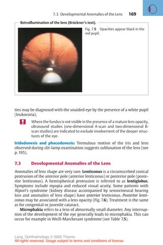 169
Retroillumination of the lens (Brückner’s test).
Fig. 7.5 Opacities appear black in the
red pupil.
ties may be diagnosed with the unaided eye by the presence of a white pupil
(leukocoria).
Where the fundus is not visible in the presence of a mature lens opacity,
ultrasound studies (one-dimensional A-scan and two-dimensional B-
scan studies) are indicated to exclude involvement of the deeper struc-
tures of the eye.
Iridodonesis and phacodonesis: Tremulous motion of the iris and lens
observed during slit-lamp examination suggests subluxation of the lens (see
p. 195).
7.3 Developmental Anomalies of the Lens
Anomalies of lens shape are very rare. Lenticonus is a circumscribed conical
protrusion of the anterior pole (anterior lenticonus) or posterior pole (poste-
rior lenticonus). A hemispherical protrusion is referred to as lentiglobus.
Symptoms include myopia and reduced visual acuity. Some patients with
Alport’s syndrome (kidney disease accompanied by sensorineural hearing
loss and anomalies of lens shape) have anterior lenticonus. Posterior lenti-
conus may be associated with a lens opacity (Fig. 7.6). Treatment is the same
as for congenital or juvenile cataract.
Microphakia refers to a lens of abnormally small diameter. Any interrup-
tion of the development of the eye generally leads to microphakia. This can
occur for example in Weill-Marchesani syndrome (see Table 7.5).
7.3 Developmental Anomalies of the Lens
Lang, Ophthalmology © 2000 Thieme
All rights reserved. Usage subject to terms and conditions of license.
 