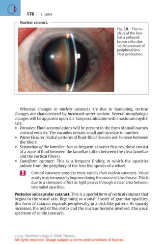 176
Whereas changes in nuclear cataracts are due to hardening, cortical
changes are characterized by increased water content. Several morphologic
changes will be apparent upon slit-lamp examination with maximum mydri-
asis:
❖ Vacuoles: Fluid accumulations will be present in the form of small narrow
cortical vesicles. The vacuoles remain small and increase in number.
❖ Water Fissures: Radial patterns of fluid-filled fissures will be seen between
the fibers.
❖ Separation of the lamellae: Not as frequent as water fissures, these consist
of a zone of fluid between the lamellae (often between the clear lamellae
and the cortical fibers).
❖ Cuneiform cataract: This is a frequent finding in which the opacities
radiate from the periphery of the lens like spokes of a wheel.
Cortical cataracts progress more rapidly than nuclear cataracts. Visual
acuity may temporarily improve during the course of the disease. This is
due to a stenopeic effect as light passes through a clear area between
two radial opacities.
Posterior subcapsular cataract. This is a special form of cortical cataract that
begins in the visual axis. Beginning as a small cluster of granular opacities,
this form of cataract expands peripherally in a disk-like pattern. As opacity
increases, the rest of the cortex and the nucleus become involved (the usual
spectrum of senile cataract).
Nuclear cataract.
Fig. 7.8 The nu-
cleus of the lens
has a yellowish
brown color due
to the pressure of
peripheral lens
fiber production.
7 Lens
Lang, Ophthalmology © 2000 Thieme
All rights reserved. Usage subject to terms and conditions of license.
 