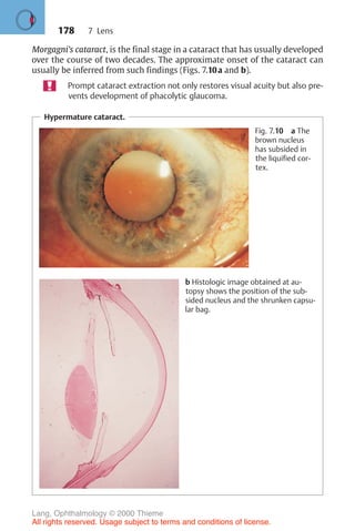 178
Morgagni’s cataract, is the final stage in a cataract that has usually developed
over the course of two decades. The approximate onset of the cataract can
usually be inferred from such findings (Figs. 7.10a and b).
Prompt cataract extraction not only restores visual acuity but also pre-
vents development of phacolytic glaucoma.
Hypermature cataract.
Fig. 7.10 a The
brown nucleus
has subsided in
the liquified cor-
tex.
b Histologic image obtained at au-
topsy shows the position of the sub-
sided nucleus and the shrunken capsu-
lar bag.
7 Lens
Lang, Ophthalmology © 2000 Thieme
All rights reserved. Usage subject to terms and conditions of license.
 