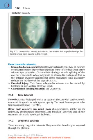 182
Contusion cataract.
Fig. 7.13 A contusion rosette posterior to the anterior lens capsule develops fol-
lowing severe blunt trauma to the eyeball.
Rarer traumatic cataracts:
❖ Infrared radiation cataract (glassblower’s cataract): This type of cataract
occurs after decades of prolonged exposure to the infrared radiation of fire
without eye protection. Characteristic findings include splitting of the
anterior lens capsule, whose edges will be observed to curl up and float in
the anterior chamber. Occupational safety regulations have drastically
reduced the incidence of this type of cataract.
❖ Electrical injury: This dense subcapsular cataract can be caused by
lightning or high-voltage electrical shock.
❖ Cataract from ionizing radiation: See Chapter 18.
7.4.6 Toxic Cataract
Steroid cataract. Prolonged topical or systemic therapy with corticosteroids
can result in a posterior subcapsular opacity. The exact dose-response rela-
tionship is not known (Fig. 7.14).
Other toxic cataracts can result from chlorpromazine, miotic agents
(especially cholinesterase inhibitors), and busulfan (Myleran) used in the
treatment of chronic myelocytic leukemia.
7.4.7 Congenital Cataract
There are many congenital cataracts. They are either hereditary or acquired
through the placenta.
7 Lens
Lang, Ophthalmology © 2000 Thieme
All rights reserved. Usage subject to terms and conditions of license.
 