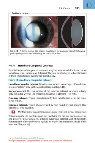 183
Cortisone cataract.
Fig. 7.14 A dense pumice-like opacity develops in the posterior capsule following
prolonged systemic steroid therapy for bronchial asthma.
7.4.7.1 Hereditary Congenital Cataracts
Familial forms of congenital cataracts may be autosomal dominant, auto-
somal recessive, sporadic, or X-linked. They are easily diagnosed on the basis
of their characteristic symmetric morphology.
Forms of hereditary congenital cataract:
Lamellar or zonular cataract. Opacities are located in one layer of lens fibers,
often as “riders” only in the equatorial region (Fig. 7.15).
Nuclear cataract. This is a variant of the lamellar cataract in which initially
only the outer layer of the embryonic nucleus is affected (Fig. 7.16).
Coronary cataract. This is characterized by fine radial opacities in the equa-
torial region.
Cerulean cataract. This is characterized by fine round or club-shaped blue
peripheral lens opacities.
Most familial lens opacities do not impair vision and are not progressive.
This also applies to rare lens opacities involving the capsule such as anterior
and posterior polar cataracts, anterior pyramidal cataract, and Mittendorf’s
dot (remnant of the embryonic hyaloid artery on the posterior capsule of the
lens; see Chapter 11).
7.4 Cataract
Lang, Ophthalmology © 2000 Thieme
All rights reserved. Usage subject to terms and conditions of license.
 
