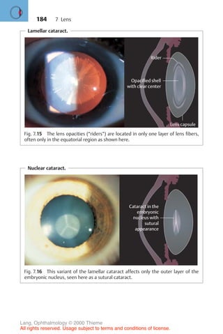184
Lamellar cataract.
Fig. 7.15 The lens opacities (“riders”) are located in only one layer of lens fibers,
often only in the equatorial region as shown here.
Nuclear cataract.
Fig. 7.16 This variant of the lamellar cataract affects only the outer layer of the
embryonic nucleus, seen here as a sutural cataract.
7 Lens
Lang, Ophthalmology © 2000 Thieme
All rights reserved. Usage subject to terms and conditions of license.
 