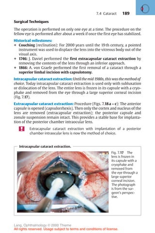 189
Intracapsular cataract extraction.
Fig. 7.17 The
lens is frozen in
its capsule with a
cryophake and
removed from
the eye through a
large superior
corneal incision.
The photograph
is from the sur-
geon’s perspec-
tive.
Surgical Techniques
The operation is performed on only one eye at a time. The procedure on the
fellow eye is performed after about a week if once the first eye has stabilized.
Historical milestones:
❖ Couching (reclination): For 2000 years until the 19 th century, a pointed
instrument was used to displace the lens into the vitreous body out of the
visual axis.
❖ 1746: J. Daviel performed the first extracapsular cataract extraction by
removing the contents of the lens through an inferior approach.
❖ 1866: A. von Graefe performed the first removal of a cataract through a
superior limbal incision with capsulotomy.
Intracapsular cataract extraction: Until the mid 1980s, this was the method of
choice. Today intracapsular cataract extraction is used only with subluxation
or dislocation of the lens. The entire lens is frozen in its capsule with a cryo-
phake and removed from the eye through a large superior corneal incision
(Fig. 7.17).
Extracapsular cataract extraction: Procedure (Figs. 7.18a – c): The anterior
capsule is opened (capsulorrhexis). Then only the cortex and nucleus of the
lens are removed (extracapsular extraction); the posterior capsule and
zonule suspension remain intact. This provides a stable base for implanta-
tion of the posterior chamber intraocular lens.
Extracapsular cataract extraction with implantation of a posterior
chamber intraocular lens is now the method of choice.
7.4 Cataract
Lang, Ophthalmology © 2000 Thieme
All rights reserved. Usage subject to terms and conditions of license.
 