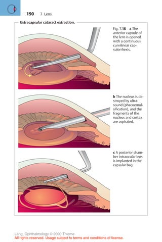 190
Extracapsular cataract extraction.
Fig. 7.18 a The
anterior capsule of
the lens is opened
with a continuous
curvilinear cap-
sulorrhexis.
b The nucleus is de-
stroyed by ultra-
sound (phacoemul-
sification), and the
fragments of the
nucleus and cortex
are aspirated.
c A posterior cham-
ber intraocular lens
is implanted in the
capsular bag.
7 Lens
Lang, Ophthalmology © 2000 Thieme
All rights reserved. Usage subject to terms and conditions of license.
 