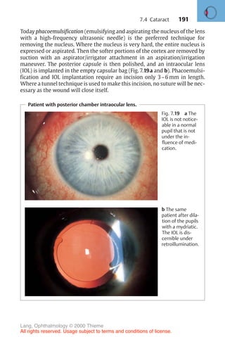 191
Today phacoemulsification (emulsifying and aspirating the nucleus of the lens
with a high-frequency ultrasonic needle) is the preferred technique for
removing the nucleus. Where the nucleus is very hard, the entire nucleus is
expressed or aspirated. Then the softer portions of the cortex are removed by
suction with an aspirator/irrigator attachment in an aspiration/irrigation
maneuver. The posterior capsule is then polished, and an intraocular lens
(IOL) is implanted in the empty capsular bag (Fig. 7.19a and b). Phacoemulsi-
fication and IOL implantation require an incision only 3–6 mm in length.
Where a tunnel technique is used to make this incision, no suture will be nec-
essary as the wound will close itself.
Patient with posterior chamber intraocular lens.
Fig. 7.19 a The
IOL is not notice-
able in a normal
pupil that is not
under the in-
fluence of medi-
cation.
b The same
patient after dila-
tion of the pupils
with a mydriatic.
The IOL is dis-
cernible under
retroillumination.
7.4 Cataract
Lang, Ophthalmology © 2000 Thieme
All rights reserved. Usage subject to terms and conditions of license.
 