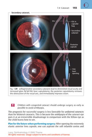 193
Secondary cataract.
Fig. 7.20 a Regenerative secondary cataracts lead to diminished visual acuity and
increased glare. b Nd:YAG laser capsulotomy: the posterior capsulotomy removes
the obstruction of the visual axis, and immediately improves vision.
Children with congenital cataract should undergo surgery as early as
possible to avoid amblyopia.
The prognosis for successful surgery is less favorable for unilateral cataracts
than for bilateral cataracts. This is because the amblyopia of the cataract eye
puts it at an irreversible disadvantage in comparison with the fellow eye as
the child learns how to see.
Plan for the future when performing surgery: After opening the extremely
elastic anterior lens capsule, one can aspirate the soft infantile cortex and
7.4 Cataract
Lang, Ophthalmology © 2000 Thieme
All rights reserved. Usage subject to terms and conditions of license.
 