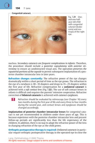 194
Congenital cataract.
Fig. 7.21 One-
and-one-half-
year-old child
with congenital
cataract (leuko-
coria) and eso-
tropia of the right
eye.
nucleus. Secondary cataracts are frequent complications in infants. Therefore,
the procedure should include a posterior capsulotomy with anterior vit-
rectomy to ensure an unobstructed visual axis. The operation preserves the
equatorial portions of the capsule to permit subsequent implantation of a pos-
terior chamber intraocular lens in later years.
Refraction changes constantly: The refractive power of the eye changes
dramatically within a short period of time as the eye grows. The refraction in
the eye of a newborn is 30–35 diopters and drops to 15–25 diopters within
the first year of life. Refractive compensation for a unilateral cataract is
achieved with a soft contact lens (Fig. 7.22). The use of soft contact lenses in
infants is difficult and requires the parents’ intensive cooperation. Refractive
correction of bilateral cataracts is achieved with cataract eyeglasses.
Refraction should be evaluated by retinoscopy (see Chapter 16) every
two months during the first year of life and every three to four months
during the second year, and contact lenses and eyeglasses should be
changed accordingly.
Implantation of posterior chamber intraocular lenses for congenital cata-
ract is not yet recommended in children under three years of age. This is
because experience with the posterior chamber intraocular lens and present
follow-up periods are significantly less than the life expectancy of the
children. In addition, there is no way to adapt the refractive power of the lens
to changing refraction of the eye as the child grows.
Orthoptic postoperative therapy is required: Unilateral cataracts in partic-
ular require orthoptic postoperative therapy in the operated eye to close the
7 Lens
Lang, Ophthalmology © 2000 Thieme
All rights reserved. Usage subject to terms and conditions of license.
 