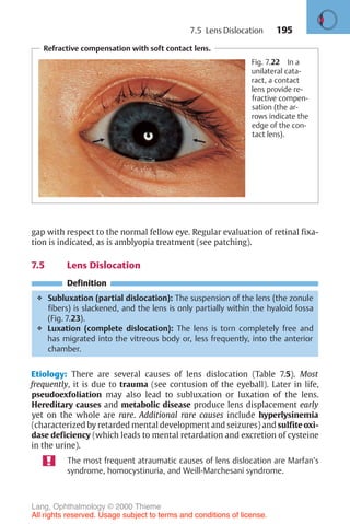 195
Refractive compensation with soft contact lens.
Fig. 7.22 In a
unilateral cata-
ract, a contact
lens provide re-
fractive compen-
sation (the ar-
rows indicate the
edge of the con-
tact lens).
gap with respect to the normal fellow eye. Regular evaluation of retinal fixa-
tion is indicated, as is amblyopia treatment (see patching).
7.5 Lens Dislocation
Definition
❖ Subluxation (partial dislocation): The suspension of the lens (the zonule
fibers) is slackened, and the lens is only partially within the hyaloid fossa
(Fig. 7.23).
❖ Luxation (complete dislocation): The lens is torn completely free and
has migrated into the vitreous body or, less frequently, into the anterior
chamber.
Etiology: There are several causes of lens dislocation (Table 7.5). Most
frequently, it is due to trauma (see contusion of the eyeball). Later in life,
pseudoexfoliation may also lead to subluxation or luxation of the lens.
Hereditary causes and metabolic disease produce lens displacement early
yet on the whole are rare. Additional rare causes include hyperlysinemia
(characterized by retarded mental development and seizures) and sulfite oxi-
dase deficiency (which leads to mental retardation and excretion of cysteine
in the urine).
The most frequent atraumatic causes of lens dislocation are Marfan’s
syndrome, homocystinuria, and Weill-Marchesani syndrome.
7.5 Lens Dislocation
Lang, Ophthalmology © 2000 Thieme
All rights reserved. Usage subject to terms and conditions of license.
 