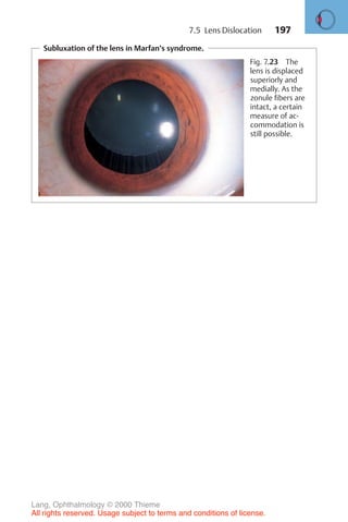 197
Subluxation of the lens in Marfan’s syndrome.
Fig. 7.23 The
lens is displaced
superiorly and
medially. As the
zonule fibers are
intact, a certain
measure of ac-
commodation is
still possible.
7.5 Lens Dislocation
Lang, Ophthalmology © 2000 Thieme
All rights reserved. Usage subject to terms and conditions of license.
 