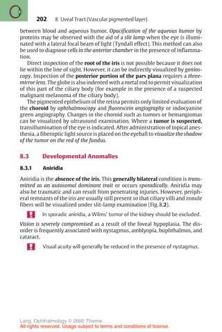202
between blood and aqueous humor. Opacification of the aqueous humor by
proteins may be observed with the aid of a slit lamp when the eye is illumi-
nated with a lateral focal beam of light (Tyndall effect). This method can also
be used to diagnose cells in the anterior chamber in the presence of inflamma-
tion.
Direct inspection of the root of the iris is not possible because it does not
lie within the line of sight. However, it can be indirectly visualized by gonios-
copy. Inspection of the posterior portion of the pars plana requires a three-
mirror lens. The globe is also indented with a metal rod to permit visualization
of this part of the ciliary body (for example in the presence of a suspected
malignant melanoma of the ciliary body).
The pigmented epithelium of the retina permits only limited evaluation of
the choroid by ophthalmoscopy and fluorescein angiography or indocyanine
green angiography. Changes in the choroid such as tumors or hemangiomas
can be visualized by ultrasound examination. Where a tumor is suspected,
transillumination of the eye is indicated. After administration of topical anes-
thesia, a fiberoptic light source is placed on the eyeball to visualize the shadow
of the tumor on the red of the fundus.
8.3 Developmental Anomalies
8.3.1 Aniridia
Aniridia is the absence of the iris. This generally bilateral condition is trans-
mitted as an autosomal dominant trait or occurs sporadically. Aniridia may
also be traumatic and can result from penetrating injuries. However, periph-
eral remnants of the iris are usually still present so that ciliary villi and zonule
fibers will be visualized under slit-lamp examination (Fig. 8.2).
In sporadic aniridia, a Wilms’ tumor of the kidney should be excluded.
Vision is severely compromised as a result of the foveal hypoplasia. The dis-
order is frequently associated with nystagmus, amblyopia, buphthalmos, and
cataract.
Visual acuity will generally be reduced in the presence of nystagmus.
8 Uveal Tract (Vascular pigmented layer)
Lang, Ophthalmology © 2000 Thieme
All rights reserved. Usage subject to terms and conditions of license.
 