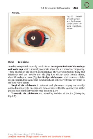 203
Aniridia.
Fig. 8.2 The cili-
ary villi (arrow)
and the lens are
visible under slit-
lamp retroillumi-
nation.
8.3.2 Coloboma
Another congenital anomaly results from incomplete fusion of the embry-
onic optic cup, which normally occurs in about the sixth week of pregnancy.
These anomalies are known as colobomas. They are directed medially and
inferiorly and can involve the iris (Fig. 8.3), ciliary body, zonule fibers,
choroid, and optic nerve (Fig. 8.4). Bridge colobomas exhibit remnants of the
iris or choroid. Involvement of the choroid and optic nerve frequently leads to
reduced visual acuity.
Surgical iris colobomas in cataract and glaucoma surgery are usually
opened superiorly. In this manner, they are covered by the upper eyelid so the
patient will not usually experience blinding glare.
Traumatic iris colobomas are caused by avulsion of the iris (iridolysis;
Fig. 8.5).
8.3 Developmental Anomalies
Lang, Ophthalmology © 2000 Thieme
All rights reserved. Usage subject to terms and conditions of license.
 