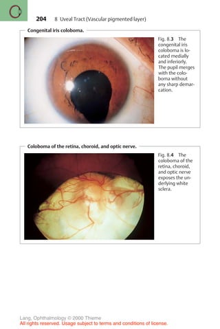 204
Congenital iris coloboma.
Fig. 8.3 The
congenital iris
coloboma is lo-
cated medially
and inferiorly.
The pupil merges
with the colo-
boma without
any sharp demar-
cation.
Coloboma of the retina, choroid, and optic nerve.
Fig. 8.4 The
coloboma of the
retina, choroid,
and optic nerve
exposes the un-
derlying white
sclera.
8 Uveal Tract (Vascular pigmented layer)
Lang, Ophthalmology © 2000 Thieme
All rights reserved. Usage subject to terms and conditions of license.
 