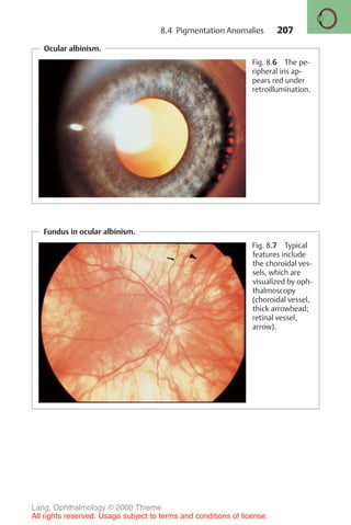 207
Ocular albinism.
Fig. 8.6 The pe-
ripheral iris ap-
pears red under
retroillumination.
Fundus in ocular albinism.
Fig. 8.7 Typical
features include
the choroidal ves-
sels, which are
visualized by oph-
thalmoscopy
(choroidal vessel,
thick arrowhead;
retinal vessel,
arrow).
8.4 Pigmentation Anomalies
Lang, Ophthalmology © 2000 Thieme
All rights reserved. Usage subject to terms and conditions of license.
 