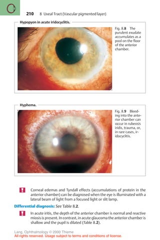 210
Hypopyon in acute iridocyclitis.
Fig. 8.8 The
purulent exudate
accumulates as a
pool on the floor
of the anterior
chamber.
Hyphema.
Fig. 8.9 Bleed-
ing into the ante-
rior chamber can
occur in rubeosis
iridis, trauma, or,
in rare cases, ir-
idocyclitis.
Corneal edemas and Tyndall effects (accumulations of protein in the
anterior chamber) can be diagnosed when the eye is illuminated with a
lateral beam of light from a focused light or slit lamp.
Differential diagnosis: See Table 8.2.
In acute iritis, the depth of the anterior chamber is normal and reactive
miosis is present. In contrast, in acute glaucoma the anterior chamber is
shallow and the pupil is dilated (Table 8.2).
8 Uveal Tract (Vascular pigmented layer)
Lang, Ophthalmology © 2000 Thieme
All rights reserved. Usage subject to terms and conditions of license.
 