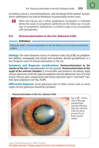 215
secondary cataract, retinal detachment, and shrinkage of the eyeball. Sympa-
thetic ophthalmia can lead to blindness in particularly severe cases.
When the injured eye is blind, prophylactic enucleation is indicated
before the onset of sympathetic ophthalmia in the fellow eye. An early
sign of sympathetic ophthalmia is a limited range of accommodation
with photophobia.
8.6 Neovascularization in the Iris: Rubeosis Iridis
Definition:
Rubeosis iridis is neovascularization in the iris that occurs in various retinal dis-
orders.
Etiology: The most frequent causes of rubeosis iridis (Fig. 8.12) are prolifera-
tive diabetic retinopathy and retinal vein occlusion. Retinal periphlebitis is a
less frequent cause of neovascularization in the iris.
Symptoms and diagnostic considerations: Neovascularization in the
stroma of the iris is asymptomatic for the patient. Neovascularization in the
angle of the anterior chamber is irreversible and produces secondary angle
closure glaucoma with the typical symptoms of acute glaucoma: loss of visual
acuity, intense pain, conjunctival and ciliary injection, and a “rock hard” eye-
ball upon palpation (see Fig. 10.17).
Differential diagnosis: Acute glaucoma due to other causes such as acute
angle closure glaucoma should be excluded.
Neovascularization in the iris: rubeosis iridis.
Fig. 8.12 Protru-
sion of the pig-
mented layer
(arrow) indicates
that the rubeosis
iridis has been
present for at
least several
weeks.
8.6 Neovascularization in the Iris: Rubeosis Iridis
Lang, Ophthalmology © 2000 Thieme
All rights reserved. Usage subject to terms and conditions of license.
 