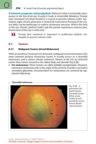 216
Treatment, prognosis, and prophylaxis: Rubeosis iridis is essentially tanta-
mount to the loss of an eye. Usually it leads to irreversible blindness. Prompt
laser treatment of retinal disorders is crucial to prevent rubeosis iridis. Sec-
ondary angle closure glaucoma is treated by transscleral freezing of the cili-
ary body (cyclocryotherapy) to reduce intraocular pressure. Where this fails
or the eye shrinks (phthisis bulbi) and the patient experiences intense pain,
enucleation of the eye is indicated.
Prompt laser treatment is important in proliferative diabetic reti-
nopathy to prevent rubeosis iridis.
8.7 Tumors
8.7.1 Malignant Tumors (Uveal Melanoma)
With an incidence of one per ten thousand, malignant uveal melanoma is the
most common primary intraocular tumor. It usually occurs as a choroidal
melanoma, and is almost always unilateral. Tumors in the iris are detected
earlier than tumors located in the ciliary body and choroid (Fig. 8.13).
❖ Iris melanomas: These tumors are often initially asymptomatic. However,
metastatic melanoma cells in the angle of the anterior chamber can lead to
secondary glaucoma. Circumscribed iris melanomas are removed by seg-
mental iridectomy.
Choroidal melanoma.
Fig. 8.13 A
prominent yel-
lowish-brown
choroidal tumor
(thick arrow-
heads) accom-
panied by serous
retinal detach-
ment (arrows).
8 Uveal Tract (Vascular pigmented layer)
Lang, Ophthalmology © 2000 Thieme
All rights reserved. Usage subject to terms and conditions of license.
 