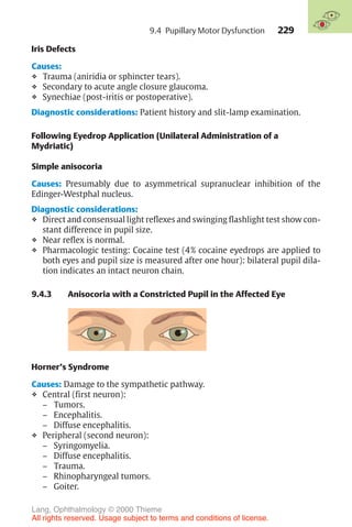 229
Iris Defects
Causes:
❖ Trauma (aniridia or sphincter tears).
❖ Secondary to acute angle closure glaucoma.
❖ Synechiae (post-iritis or postoperative).
Diagnostic considerations: Patient history and slit-lamp examination.
Following Eyedrop Application (Unilateral Administration of a
Mydriatic)
Simple anisocoria
Causes: Presumably due to asymmetrical supranuclear inhibition of the
Edinger-Westphal nucleus.
Diagnostic considerations:
❖ Direct and consensual light reflexes and swinging flashlight test show con-
stant difference in pupil size.
❖ Near reflex is normal.
❖ Pharmacologic testing: Cocaine test (4% cocaine eyedrops are applied to
both eyes and pupil size is measured after one hour): bilateral pupil dila-
tion indicates an intact neuron chain.
9.4.3 Anisocoria with a Constricted Pupil in the Affected Eye
Horner’s Syndrome
Causes: Damage to the sympathetic pathway.
❖ Central (first neuron):
– Tumors.
– Encephalitis.
– Diffuse encephalitis.
❖ Peripheral (second neuron):
– Syringomyelia.
– Diffuse encephalitis.
– Trauma.
– Rhinopharyngeal tumors.
– Goiter.
9.4 Pupillary Motor Dysfunction
Lang, Ophthalmology © 2000 Thieme
All rights reserved. Usage subject to terms and conditions of license.
 