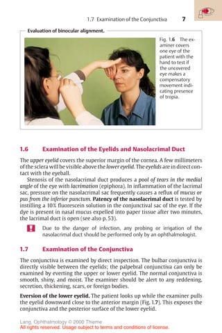 7
Evaluation of binocular alignment.
Fig. 1.6 The ex-
aminer covers
one eye of the
patient with the
hand to test if
the uncovered
eye makes a
compensatory
movement indi-
cating presence
of tropia.
1.6 Examination of the Eyelids and Nasolacrimal Duct
The upper eyelid covers the superior margin of the cornea. A few millimeters
of the sclera will be visible above the lower eyelid. The eyelids are in direct con-
tact with the eyeball.
Stenosis of the nasolacrimal duct produces a pool of tears in the medial
angle of the eye with lacrimation (epiphora). In inflammation of the lacrimal
sac, pressure on the nasolacrimal sac frequently causes a reflux of mucus or
pus from the inferior punctum. Patency of the nasolacrimal duct is tested by
instilling a 10% fluorescein solution in the conjunctival sac of the eye. If the
dye is present in nasal mucus expelled into paper tissue after two minutes,
the lacrimal duct is open (see also p. 53).
Due to the danger of infection, any probing or irrigation of the
nasolacrimal duct should be performed only by an ophthalmologist.
1.7 Examination of the Conjunctiva
The conjunctiva is examined by direct inspection. The bulbar conjunctiva is
directly visible between the eyelids; the palpebral conjunctiva can only be
examined by everting the upper or lower eyelid. The normal conjunctiva is
smooth, shiny, and moist. The examiner should be alert to any reddening,
secretion, thickening, scars, or foreign bodies.
Eversion of the lower eyelid. The patient looks up while the examiner pulls
the eyelid downward close to the anterior margin (Fig. 1.7). This exposes the
conjunctiva and the posterior surface of the lower eyelid.
1.7 Examination of the Conjunctiva
Lang, Ophthalmology © 2000 Thieme
All rights reserved. Usage subject to terms and conditions of license.
 