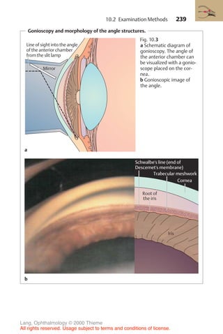 239
Gonioscopy and morphology of the angle structures.
Line of sight into the angle
of the anterior chamber
from the slit lamp
*
*
Mirror
Fig. 10.3
a Schematic diagram of
gonioscopy. The angle of
the anterior chamber can
be visualized with a gonio-
scope placed on the cor-
nea.
b Gonioscopic image of
the angle.
a
b
10.2 Examination Methods
Lang, Ophthalmology © 2000 Thieme
All rights reserved. Usage subject to terms and conditions of license.
 