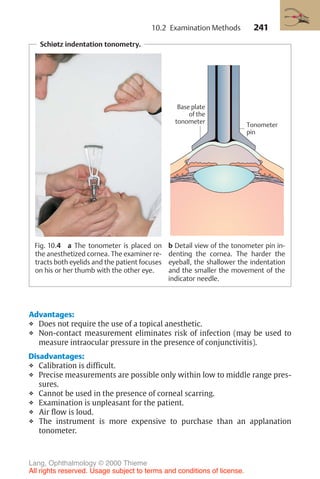 241
Schiøtz indentation tonometry.
Fig. 10.4 a The tonometer is placed on
the anesthetized cornea. The examiner re-
tracts both eyelids and the patient focuses
on his or her thumb with the other eye.
b Detail view of the tonometer pin in-
denting the cornea. The harder the
eyeball, the shallower the indentation
and the smaller the movement of the
indicator needle.
Advantages:
❖ Does not require the use of a topical anesthetic.
❖ Non-contact measurement eliminates risk of infection (may be used to
measure intraocular pressure in the presence of conjunctivitis).
Disadvantages:
❖ Calibration is difficult.
❖ Precise measurements are possible only within low to middle range pres-
sures.
❖ Cannot be used in the presence of corneal scarring.
❖ Examination is unpleasant for the patient.
❖ Air flow is loud.
❖ The instrument is more expensive to purchase than an applanation
tonometer.
Tonometer
pin
Base plate
of the
tonometer
10.2 Examination Methods
Lang, Ophthalmology © 2000 Thieme
All rights reserved. Usage subject to terms and conditions of license.
 