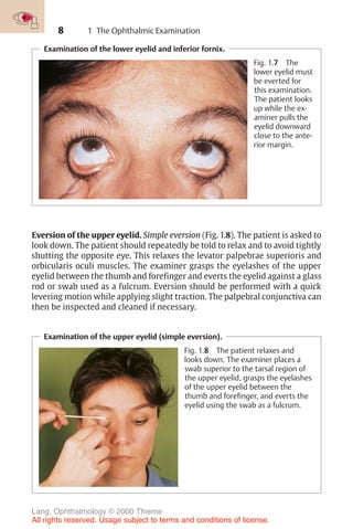 8
Examination of the lower eyelid and inferior fornix.
Fig. 1.7 The
lower eyelid must
be everted for
this examination.
The patient looks
up while the ex-
aminer pulls the
eyelid downward
close to the ante-
rior margin.
Examination of the upper eyelid (simple eversion).
Fig. 1.8 The patient relaxes and
looks down. The examiner places a
swab superior to the tarsal region of
the upper eyelid, grasps the eyelashes
of the upper eyelid between the
thumb and forefinger, and everts the
eyelid using the swab as a fulcrum.
Eversion of the upper eyelid. Simple eversion (Fig. 1.8). The patient is asked to
look down. The patient should repeatedly be told to relax and to avoid tightly
shutting the opposite eye. This relaxes the levator palpebrae superioris and
orbicularis oculi muscles. The examiner grasps the eyelashes of the upper
eyelid between the thumb and forefinger and everts the eyelid against a glass
rod or swab used as a fulcrum. Eversion should be performed with a quick
levering motion while applying slight traction. The palpebral conjunctiva can
then be inspected and cleaned if necessary.
1 The Ophthalmic Examination
Lang, Ophthalmology © 2000 Thieme
All rights reserved. Usage subject to terms and conditions of license.
 