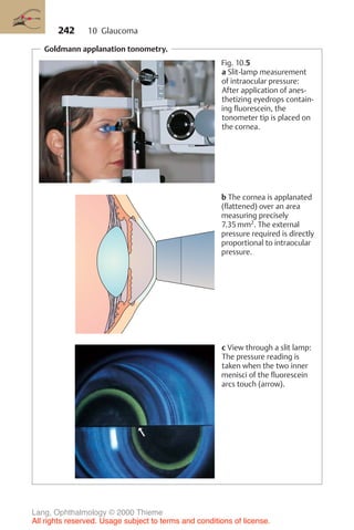 242
Goldmann applanation tonometry.
Fig. 10.5
a Slit-lamp measurement
of intraocular pressure:
After application of anes-
thetizing eyedrops contain-
ing fluorescein, the
tonometer tip is placed on
the cornea.
b The cornea is applanated
(flattened) over an area
measuring precisely
7.35 mm2
. The external
pressure required is directly
proportional to intraocular
pressure.
c View through a slit lamp:
The pressure reading is
taken when the two inner
menisci of the fluorescein
arcs touch (arrow).
10 Glaucoma
Lang, Ophthalmology © 2000 Thieme
All rights reserved. Usage subject to terms and conditions of license.
 