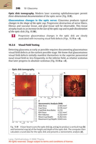 246
Optic disk tomography. Modern laser scanning ophthalmoscopes permit
three-dimensional documentation of the optic nerve (Fig. 10.9).
Glaucomatous changes in the optic nerve: Glaucoma produces typical
changes in the shape of the optic cup. Progressive destruction of nerve fibers,
fibrous and vascular tissue, and glial tissue will be observable. This tissue
atrophy leads to an increase in the size of the optic cup and to pale discoloration
of the optic disk (Fig. 10.10).
Progressive glaucomatous changes in the optic disk are closely
associated with increasing visual field defects (Figs. 10.11a – d).
10.2.6 Visual Field Testing
Detecting glaucoma as early as possible requires documenting glaucomatous
visual field defects at the earliest possible stage. We know that glaucomatous
visual field defects initially manifest themselves in the superior paracentral
nasal visual field or, less frequently, in the inferior field, as relative scotomas
that later progress to absolute scotomas (Fig. 10.11a – d).
Optic disk tomography.
0.00 0.50 1.00 1.50 2.00 2.50
x (mm)
1.80
1.60
1.40
1.20
1.00
0.80
0.60
0.40
0.20
0.00
-0.20
-0.40
-0.60
-0.80
-1.00
z
(mm)
2.50
2.00
1.50
1.00
0.50
0.00
0.00 0.50 1.00 1.50 2.00 2.50
y
(mm)
x (mm)
a1
1.50 1.00 0.50 0.00 -0.50 -1.00
2.80
2.60
2.40
2.20
2.00
1.80
1.60
1.40
1.20
1.00
0.80
0.60
0.40
0.20
0.00
y
(mm)
a2
b
z (mm)
Stereometric Analysis OHN:
Disk Area: 2.103 mm2
Cup Area: 0.576 mm2
Cup/Disk Area Ratio: 0.274
Rim Area: 1.527 mm2
Rim Volume: 0.322 mm3
Mean Cup Depth: 0.262 mm
Maximum Cup Depth: 0.843 mm
c
d
Fig. 10.9 A laser beam scans the optic disk (a1 and a2) to produce a vertical map (b)
and horizontal map (c) of the height and depth of the optic disk. The computer then
calculates crucial data for the optic disk and presents a stereometric analysis (d).
10 Glaucoma
Lang, Ophthalmology © 2000 Thieme
All rights reserved. Usage subject to terms and conditions of license.
 