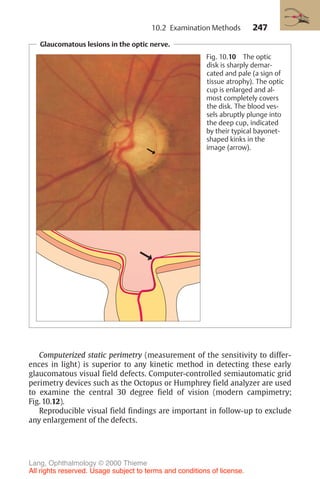 247
Glaucomatous lesions in the optic nerve.
➞
Fig. 10.10 The optic
disk is sharply demar-
cated and pale (a sign of
tissue atrophy). The optic
cup is enlarged and al-
most completely covers
the disk. The blood ves-
sels abruptly plunge into
the deep cup, indicated
by their typical bayonet-
shaped kinks in the
image (arrow).
Computerized static perimetry (measurement of the sensitivity to differ-
ences in light) is superior to any kinetic method in detecting these early
glaucomatous visual field defects. Computer-controlled semiautomatic grid
perimetry devices such as the Octopus or Humphrey field analyzer are used
to examine the central 30 degree field of vision (modern campimetry;
Fig. 10.12).
Reproducible visual field findings are important in follow-up to exclude
any enlargement of the defects.
10.2 Examination Methods
Lang, Ophthalmology © 2000 Thieme
All rights reserved. Usage subject to terms and conditions of license.
 