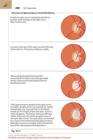 248
Overview of glaucomatous visual field defects.
Fig. 10.11
Peripheral optic cup in a temporal and inferior
location (with damage to the optic nerve
fibers in this area).
Increase in the size of the optic cup with thinning
of the vital rim. The lamina cribrosa is visible.
Advanced generalized thinning of the
neuroretinal rim with an increasingly visible
lamina cribrosa and nasal displacement of
the blood vessels.
Total glaucomatous atrophy of the optic nerve:
Complete atrophy of the neuroretinal rim, kettle-
shaped optic cup, bayonet kinks in the blood
vessels on the margin of the optic disk, some of
which disappear. The lamina cribrosa is diffusely
visible. Only remnants of the atrophic tissue of
the optic disk remain. The optic disk is surrounded
by a ring of chorioretinal atrophy (glaucomatous
halo) due to pressure atrophy of the choroid and
lysis of the retinal pigmented epithelium.
10 Glaucoma
Lang, Ophthalmology © 2000 Thieme
All rights reserved. Usage subject to terms and conditions of license.
 