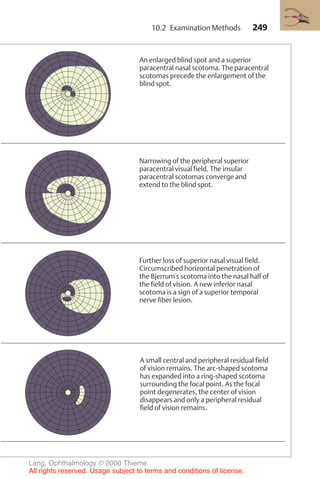 249
An enlarged blind spot and a superior
paracentral nasal scotoma. The paracentral
scotomas precede the enlargement of the
blind spot.
Narrowing of the peripheral superior
paracentral visual field. The insular
paracentral scotomas converge and
extend to the blind spot.
Further loss of superior nasal visual field.
Circumscribed horizontal penetration of
the Bjerrum's scotoma into the nasal half of
the field of vision. A new inferior nasal
scotoma is a sign of a superior temporal
nerve fiber lesion.
A small central and peripheral residual field
of vision remains. The arc-shaped scotoma
has expanded into a ring-shaped scotoma
surrounding the focal point. As the focal
point degenerates, the center of vision
disappears and only a peripheral residual
field of vision remains.
10.2 Examination Methods
Lang, Ophthalmology © 2000 Thieme
All rights reserved. Usage subject to terms and conditions of license.
 