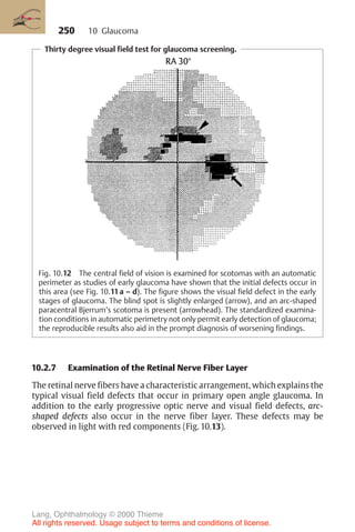 250
Thirty degree visual field test for glaucoma screening.
Fig. 10.12 The central field of vision is examined for scotomas with an automatic
perimeter as studies of early glaucoma have shown that the initial defects occur in
this area (see Fig. 10.11a – d). The figure shows the visual field defect in the early
stages of glaucoma. The blind spot is slightly enlarged (arrow), and an arc-shaped
paracentral Bjerrum’s scotoma is present (arrowhead). The standardized examina-
tion conditions in automatic perimetry not only permit early detection of glaucoma;
the reproducible results also aid in the prompt diagnosis of worsening findings.
10.2.7 Examination of the Retinal Nerve Fiber Layer
The retinal nerve fibers have a characteristic arrangement, which explains the
typical visual field defects that occur in primary open angle glaucoma. In
addition to the early progressive optic nerve and visual field defects, arc-
shaped defects also occur in the nerve fiber layer. These defects may be
observed in light with red components (Fig. 10.13).
10 Glaucoma
Lang, Ophthalmology © 2000 Thieme
All rights reserved. Usage subject to terms and conditions of license.
 