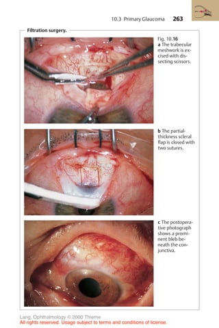 263
Filtration surgery.
Fig. 10.16
a The trabecular
meshwork is ex-
cised with dis-
secting scissors.
b The partial-
thickness scleral
flap is closed with
two sutures.
c The postopera-
tive photograph
shows a promi-
nent bleb be-
neath the con-
junctiva.
10.3 Primary Glaucoma
Lang, Ophthalmology © 2000 Thieme
All rights reserved. Usage subject to terms and conditions of license.
 