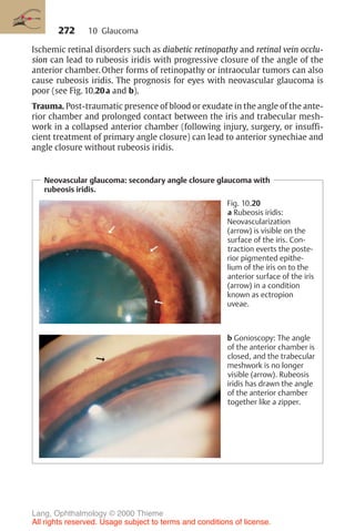 272
Ischemic retinal disorders such as diabetic retinopathy and retinal vein occlu-
sion can lead to rubeosis iridis with progressive closure of the angle of the
anterior chamber. Other forms of retinopathy or intraocular tumors can also
cause rubeosis iridis. The prognosis for eyes with neovascular glaucoma is
poor (see Fig. 10.20a and b).
Trauma. Post-traumatic presence of blood or exudate in the angle of the ante-
rior chamber and prolonged contact between the iris and trabecular mesh-
work in a collapsed anterior chamber (following injury, surgery, or insuffi-
cient treatment of primary angle closure) can lead to anterior synechiae and
angle closure without rubeosis iridis.
Neovascular glaucoma: secondary angle closure glaucoma with
rubeosis iridis.
Fig. 10.20
a Rubeosis iridis:
Neovascularization
(arrow) is visible on the
surface of the iris. Con-
traction everts the poste-
rior pigmented epithe-
lium of the iris on to the
anterior surface of the iris
(arrow) in a condition
known as ectropion
uveae.
b Gonioscopy: The angle
of the anterior chamber is
closed, and the trabecular
meshwork is no longer
visible (arrow). Rubeosis
iridis has drawn the angle
of the anterior chamber
together like a zipper.
10 Glaucoma
Lang, Ophthalmology © 2000 Thieme
All rights reserved. Usage subject to terms and conditions of license.
 