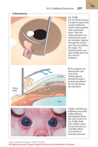 277
Trabeculotomy.
Fig. 10.22
a A 12 o’clock incision
is made to expose the
canal of Schlemm,
which is then probed
with a trabeculo-
tome. Then the
trabeculotome is ro-
tated into the ante-
rior chamber, tearing
through the embry-
onic tissue occluding
the angle. The
aqueous humor can
now readily drain into
the canal of
Schlemm.
b The surgeon can
observe the rota-
tion of the
trabeculotome
directly through a
gonioscope placed
on the eye during
the operation.
c Right and left eyes
following successful
trabeculotomy
(photograph shows
the same child as in
Fig. 10.21). Both
eyes exhibit a clear
cornea (normal cor-
neal light reflex)
and normal in-
traocular pressure.
Cornea
Lens
Ciliary
body
Trabecular meshwork
10.5 Childhood Glaucomas
Lang, Ophthalmology © 2000 Thieme
All rights reserved. Usage subject to terms and conditions of license.
 