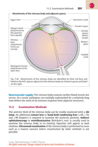 281
Attachments of the vitreous body and adjacent spaces.
Martegiani's funnel
(attachment at the
optic disc)
Hannover's canal
Vitreous
base
(attachment
to the ora
serrata)
Wieger's band
(attachment to
the posterior
lens capsule)
Garnier's space
Zonular
spaces
(Petit's
canals)
Berger's
space
Hyaloid
canal
Egger's line
Fig. 11.2 Attachments of the vitreous body are identified by thick red lines and
listed on the left. Spaces adjacent to the vitreous body are shown in green and listed
on the right.
Neurovascular supply: The vitreous body contains neither blood vessels nor
nerves. As a result, pathogens can multiply undisturbed for a relatively long
time before the onset of an immune response from adjacent structures.
11.2 Examination Methods
The anterior third of the vitreous body can be readily examined with a slit
lamp. An additional contact lens or hand-held condensing lens (+ 60, + 78,
and + 90 diopters) is required to examine the posterior portions. Indirect
ophthalmoscopy or retroillumination (Brückner’s test) is usually used to
examine the vitreous body in its entirety. Opacities will appear as dark
shadows. Ultrasound examination of the vitreous body is performed in cases
such as a mature cataract where visualization by other methods is not
possible.
11.2 Examination Methods
Lang, Ophthalmology © 2000 Thieme
All rights reserved. Usage subject to terms and conditions of license.
 