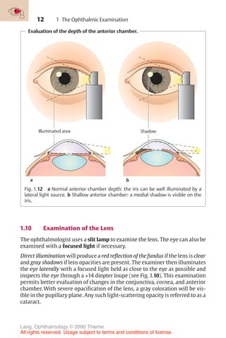 12
Evaluation of the depth of the anterior chamber.
Illuminated area
a
Shadow
b
Fig. 1.12 a Normal anterior chamber depth: the iris can be well illuminated by a
lateral light source. b Shallow anterior chamber: a medial shadow is visible on the
iris.
1 The Ophthalmic Examination
1.10 Examination of the Lens
The ophthalmologist uses a slit lamp to examine the lens. The eye can also be
examined with a focused light if necessary.
Direct illumination will produce a red reflection of the fundus if the lens is clear
and gray shadows if lens opacities are present. The examiner then illuminates
the eye laterally with a focused light held as close to the eye as possible and
inspects the eye through a +14 diopter loupe (see Fig. 1.10). This examination
permits better evaluation of changes in the conjunctiva, cornea, and anterior
chamber. With severe opacification of the lens, a gray coloration will be vis-
ible in the pupillary plane. Any such light-scattering opacity is referred to as a
cataract.
Lang, Ophthalmology © 2000 Thieme
All rights reserved. Usage subject to terms and conditions of license.
 
